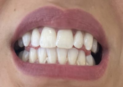 Hautlicht Saarbrücken Zahnbleaching