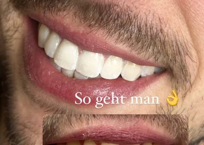 Hautlicht Saarbrücken Zahnbleaching
