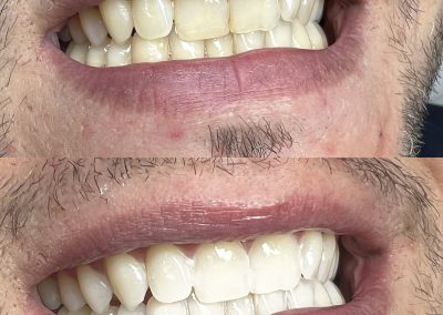 Hautlicht Saarbrücken Zahnbleaching