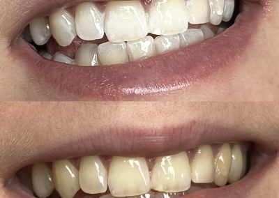 Hautlicht Saarbrücken Zahnbleaching